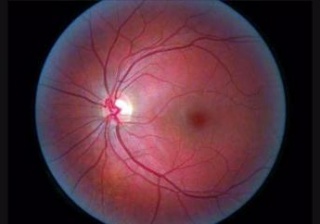 Флуоресцентная ангиография глазного дна